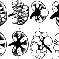 Фото: Аномалии почек