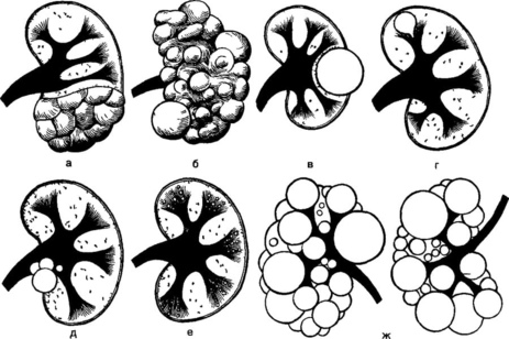 Фото: Аномалии почек