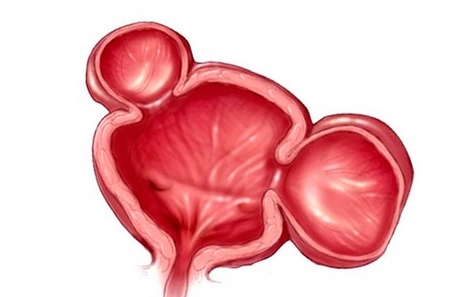 Фото: Врожденные аномалии мочевого пузыря: мировые и отечественные данные