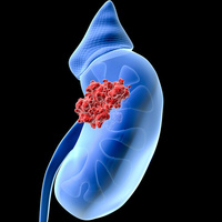 Фото: Рак почки