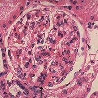 Фото: Болезнь Берже