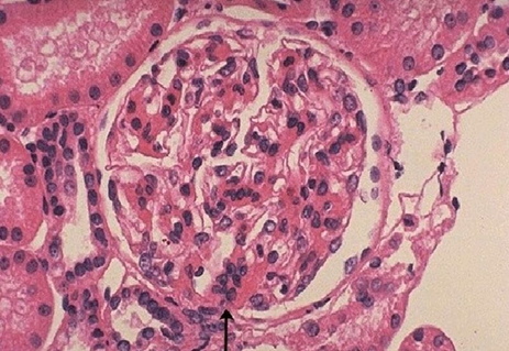 Фото: Болезнь Берже