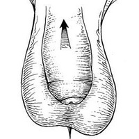 Фото: Фимоз