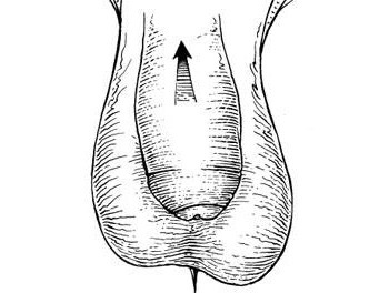 Фото: Фимоз