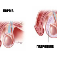 Фото: Гидроцеле