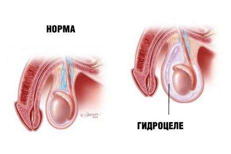 Фото: Гидроцеле