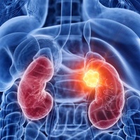 Фото: Гипернефрома