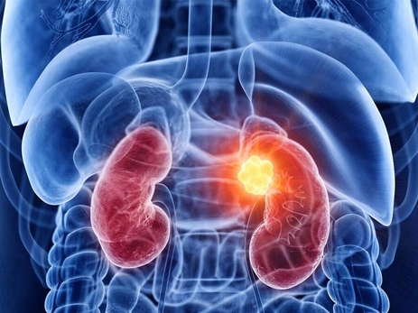 Фото: Гипернефрома