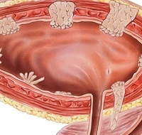 Фото: Рак мочевого пузыря