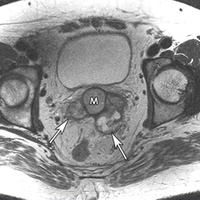 Фото: Опухоли семенных пузырьков