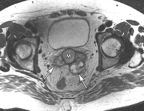 Фото: Опухоли семенных пузырьков