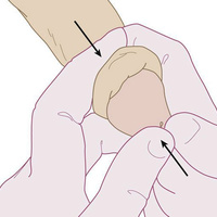 Фото: Парафимоз