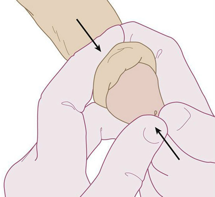 Фото: Парафимоз