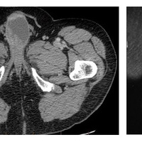Фото: Рак полового члена