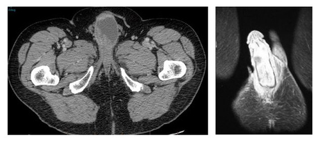 Фото: Рак полового члена