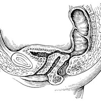 Фото: Мочеполовые свищи у женщин