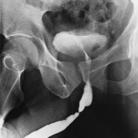 Фото: Травма уретры