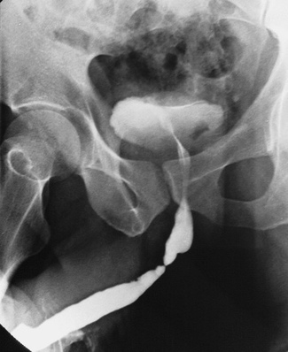 Фото: Травма уретры