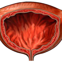 Фото: Недержание мочи у женщин