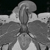 Фото: Травма полового члена