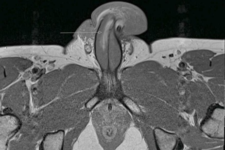 Фото: Травма полового члена