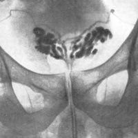 Фото: Везикулит