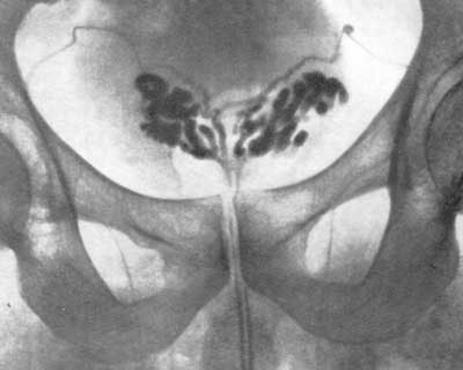 Фото: Везикулит