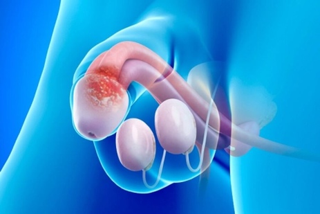 Фото: Баланопостит - воспаления полового члена