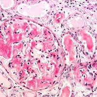 Фото: Амилоидоз почек