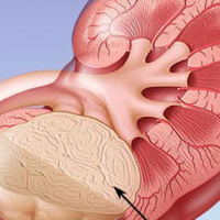 Фото: Ангиолипомы почек