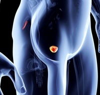 Фото: Рак предстательной железы (рак простаты)