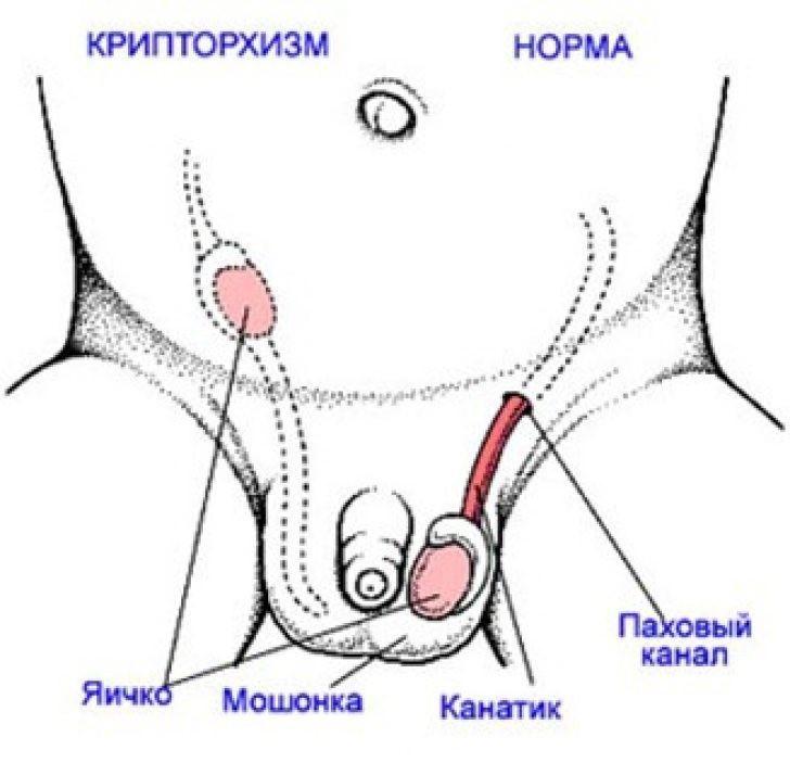 Фото: Крипторхизм