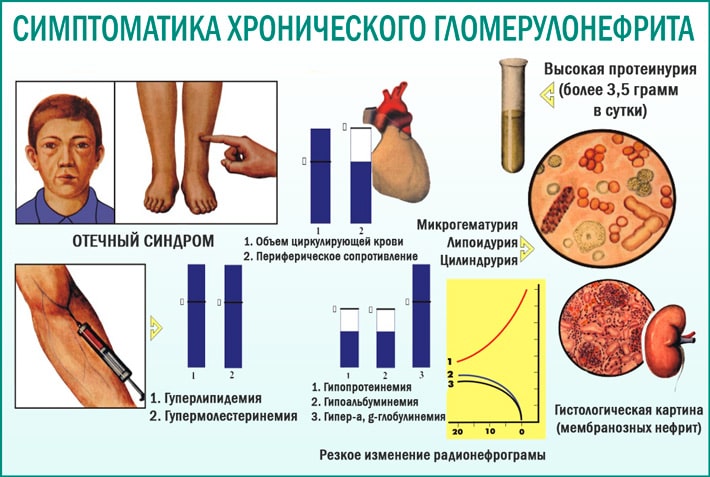 Фото: Симптомы гломерулонефрита